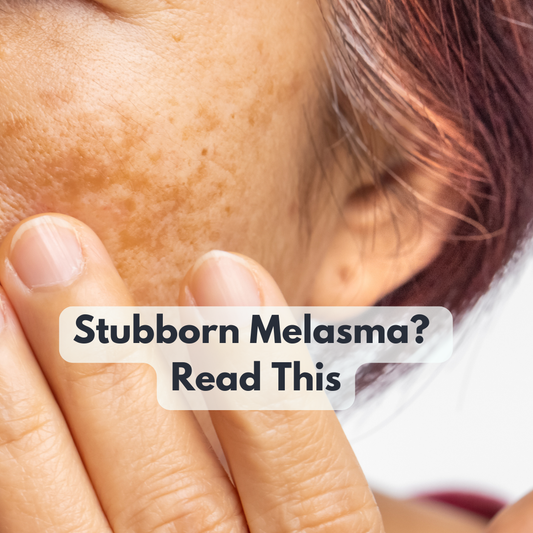 Melasma on the Face: Why It Happens, Why It Keeps Coming Back, and How to Care for It Gently