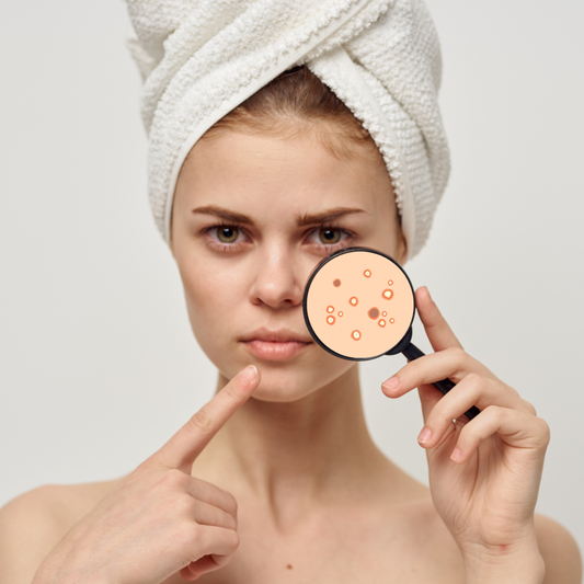 A women with a head towel out of shower examining her facial skin with a magnifying glass looking unhappy with clogged pores